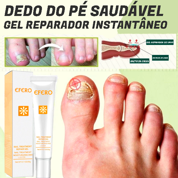 Fungus Remover - Gel Antifúngico instatanêo