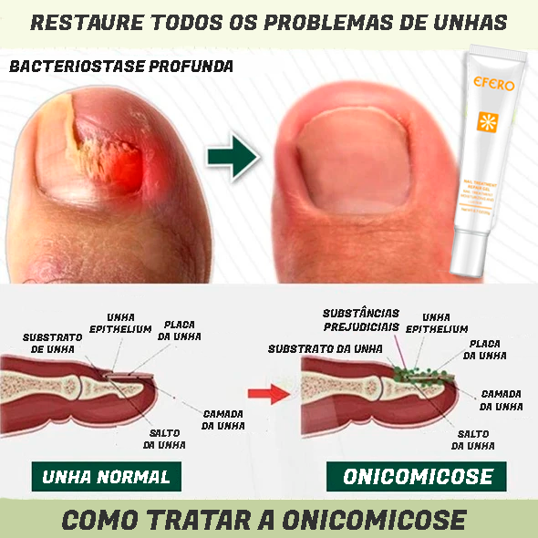 Fungus Remover - Gel Antifúngico instatanêo